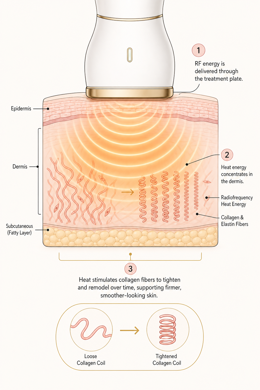 How radiofrequency works